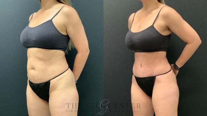 Tummy Tuck Case 587 Before & After Left Oblique | The Woodlands, TX | The Gill Center for Plastic Surgery and Dermatology