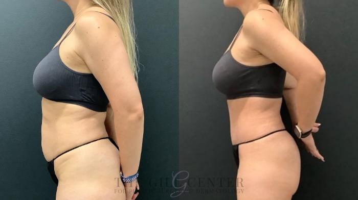 Tummy Tuck Case 587 Before & After Left Side | The Woodlands, TX | The Gill Center for Plastic Surgery and Dermatology