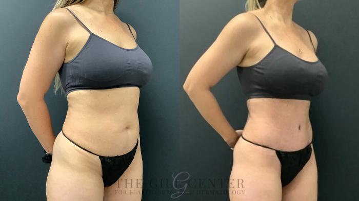 Tummy Tuck Case 587 Before & After Right Oblique | The Woodlands, TX | The Gill Center for Plastic Surgery and Dermatology