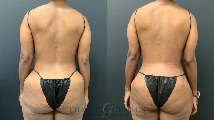 Tummy Tuck Case 588 Before & After Back | The Woodlands, TX | The Gill Center for Plastic Surgery and Dermatology