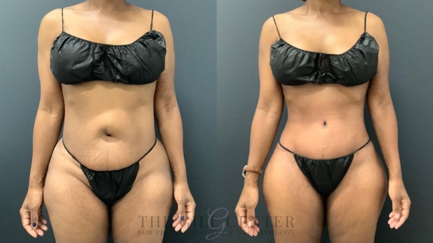 Tummy Tuck Case 588 Before & After Front | The Woodlands, TX | The Gill Center for Plastic Surgery and Dermatology