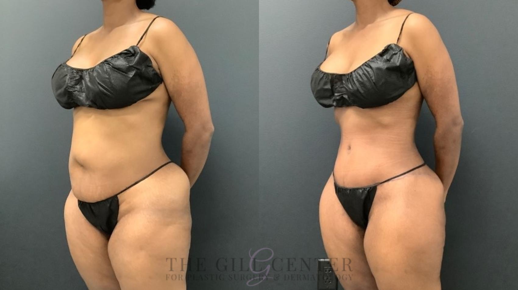 Tummy Tuck Case 588 Before & After Left Oblique | The Woodlands, TX | The Gill Center for Plastic Surgery and Dermatology