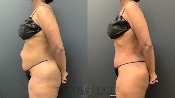 Tummy Tuck Case 588 Before & After Left Side | The Woodlands, TX | The Gill Center for Plastic Surgery and Dermatology