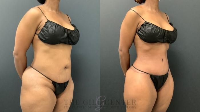 Tummy Tuck Case 588 Before & After Right Oblique | The Woodlands, TX | The Gill Center for Plastic Surgery and Dermatology