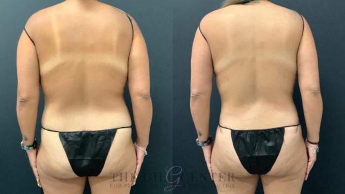 Tummy Tuck Case 589 Before & After Back | The Woodlands, TX | The Gill Center for Plastic Surgery and Dermatology
