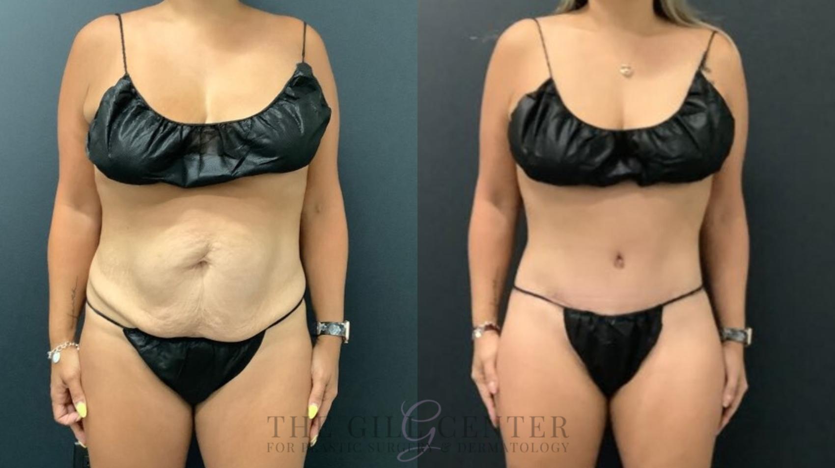 Tummy Tuck Case 589 Before & After Front | The Woodlands, TX | The Gill Center for Plastic Surgery and Dermatology