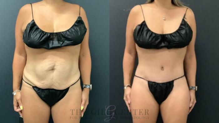 Tummy Tuck Case 589 Before & After Front | The Woodlands, TX | The Gill Center for Plastic Surgery and Dermatology