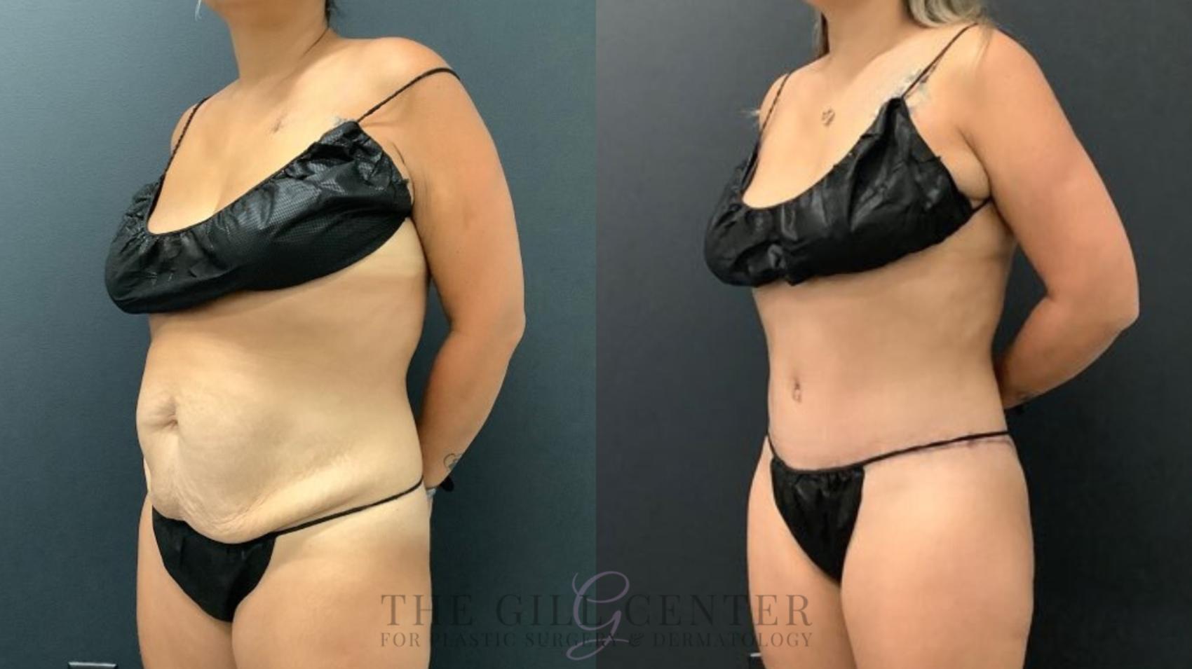 Tummy Tuck Case 589 Before & After Left Oblique | The Woodlands, TX | The Gill Center for Plastic Surgery and Dermatology