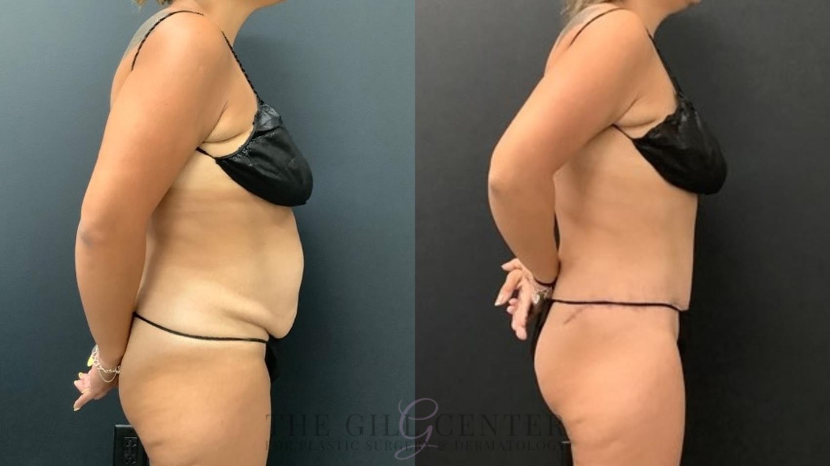 Tummy Tuck Case 589 Before & After Right Side | The Woodlands, TX | The Gill Center for Plastic Surgery and Dermatology