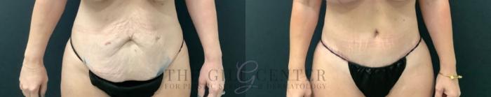 Tummy Tuck Case 590 Before & After Front | The Woodlands, TX | The Gill Center for Plastic Surgery and Dermatology