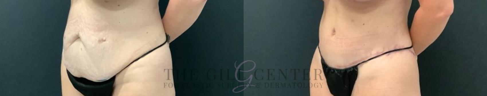 Tummy Tuck Case 590 Before & After Left Oblique | The Woodlands, TX | The Gill Center for Plastic Surgery and Dermatology