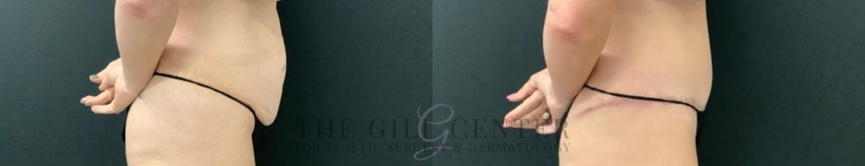 Tummy Tuck Case 590 Before & After Right Side | The Woodlands, TX | The Gill Center for Plastic Surgery and Dermatology