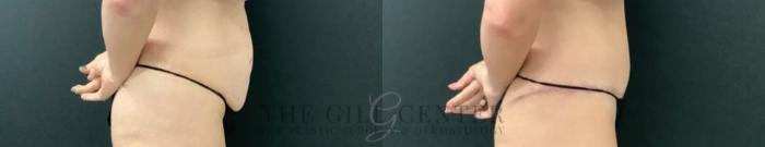 Tummy Tuck Case 590 Before & After Right Side | The Woodlands, TX | The Gill Center for Plastic Surgery and Dermatology