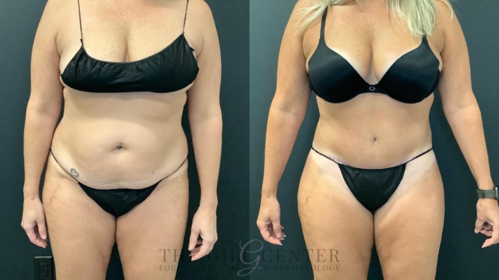 Tummy Tuck Surgery in The Woodlands, Conroe & Spring, TX