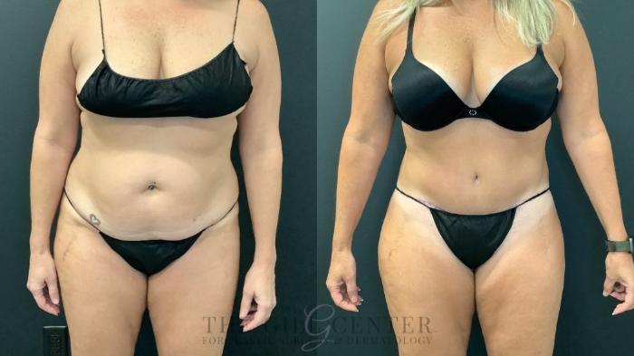 Tummy Tuck Case 591 Before & After Front | The Woodlands, TX | The Gill Center for Plastic Surgery and Dermatology