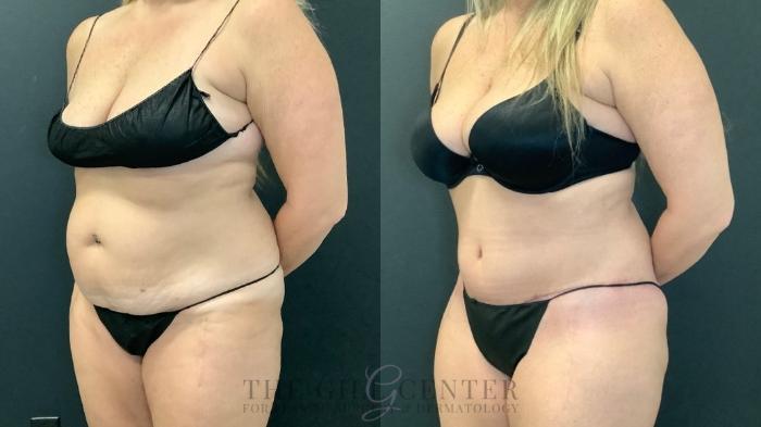 Tummy Tuck Case 591 Before & After Left Oblique | The Woodlands, TX | The Gill Center for Plastic Surgery and Dermatology