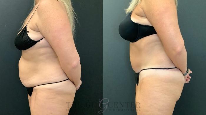 Tummy Tuck Case 591 Before & After Left Side | The Woodlands, TX | The Gill Center for Plastic Surgery and Dermatology