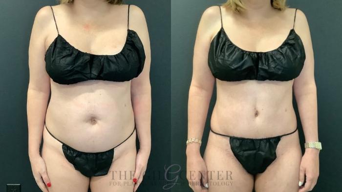 Tummy Tuck Case 592 Before & After Front | The Woodlands, TX | The Gill Center for Plastic Surgery and Dermatology