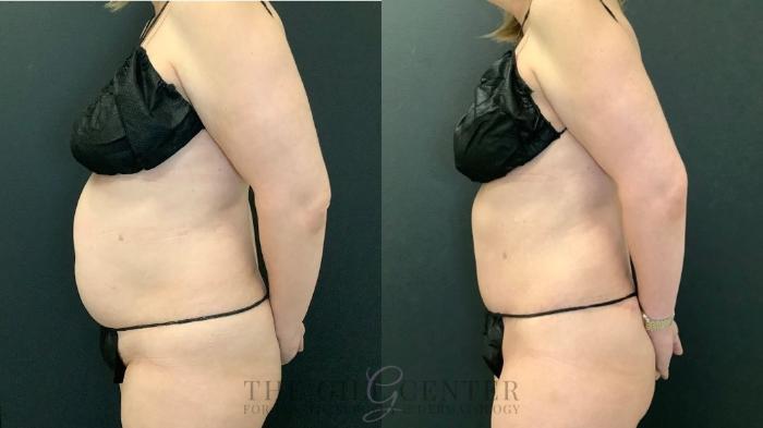Tummy Tuck Case 592 Before & After Left Side | The Woodlands, TX | The Gill Center for Plastic Surgery and Dermatology