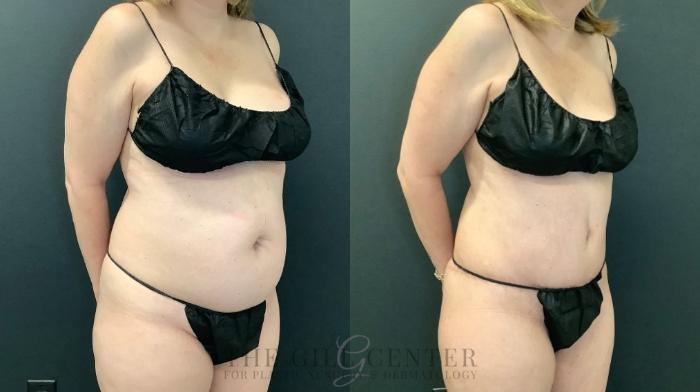 Tummy Tuck Case 592 Before & After Right Side | The Woodlands, TX | The Gill Center for Plastic Surgery and Dermatology
