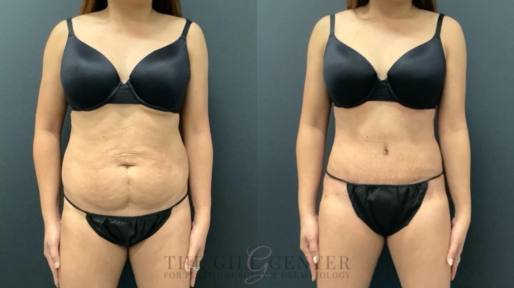Tummy Tuck Case 620 Before & After Front | The Woodlands, TX | The Gill Center for Plastic Surgery and Dermatology