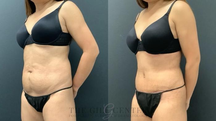 Tummy Tuck Case 620 Before & After Left Oblique | The Woodlands, TX | The Gill Center for Plastic Surgery and Dermatology