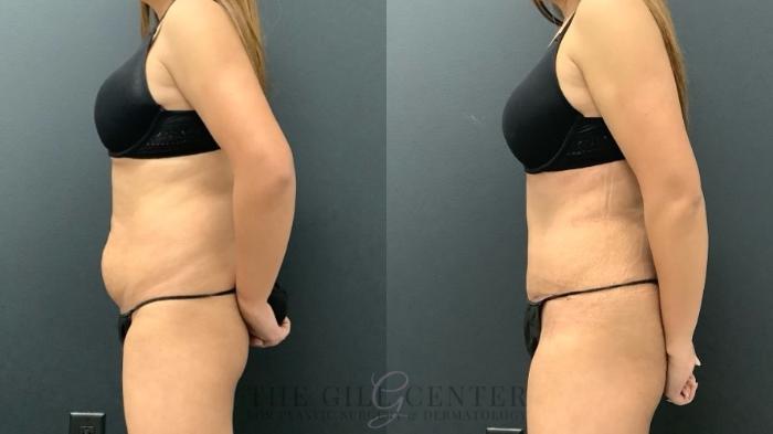 Tummy Tuck Case 620 Before & After Left Side | The Woodlands, TX | The Gill Center for Plastic Surgery and Dermatology