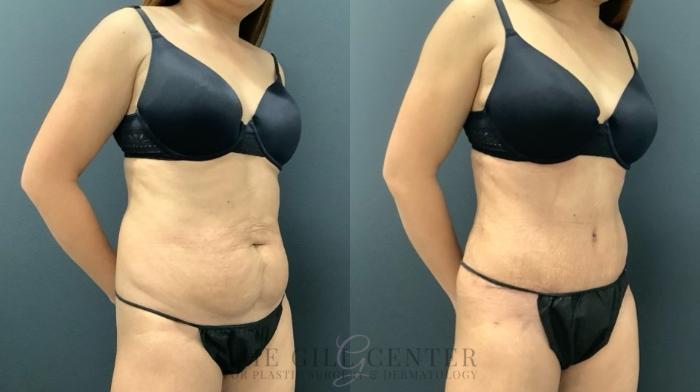 Tummy Tuck Case 620 Before & After Right Oblique | The Woodlands, TX | The Gill Center for Plastic Surgery and Dermatology
