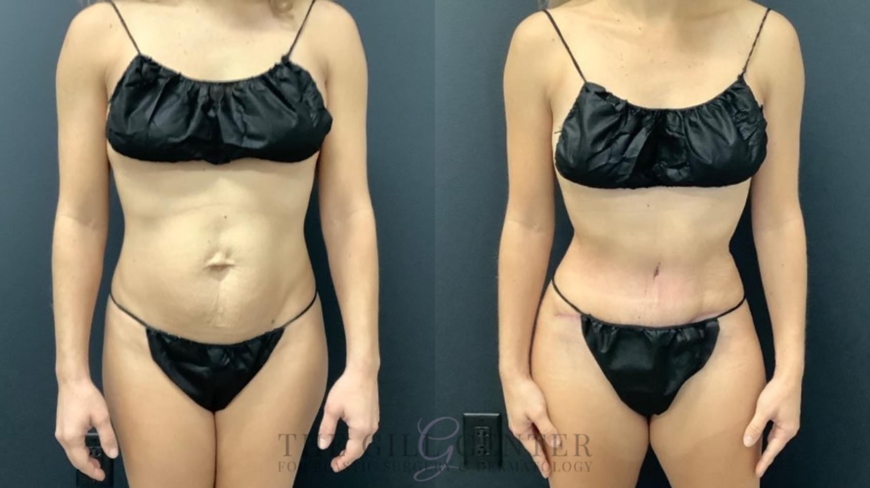 Tummy Tuck Case 622 Before & After Front | The Woodlands, TX | The Gill Center for Plastic Surgery and Dermatology