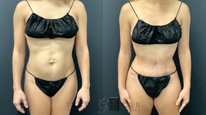 Tummy Tuck Case 622 Before & After Front | The Woodlands, TX | The Gill Center for Plastic Surgery and Dermatology