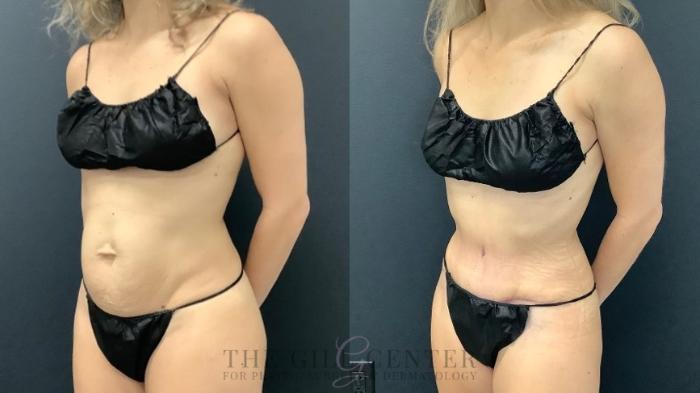 Tummy Tuck Case 622 Before & After Left Oblique | The Woodlands, TX | The Gill Center for Plastic Surgery and Dermatology