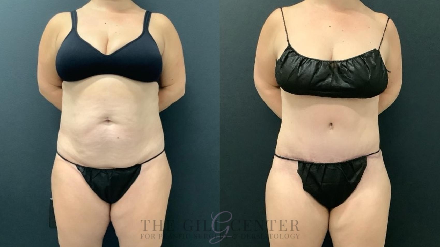 Tummy Tuck Case 631 Before & After Front | The Woodlands, TX | The Gill Center for Plastic Surgery and Dermatology