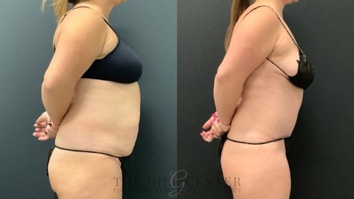 Tummy Tuck Case 631 Before & After Right Oblique | The Woodlands, TX | The Gill Center for Plastic Surgery and Dermatology