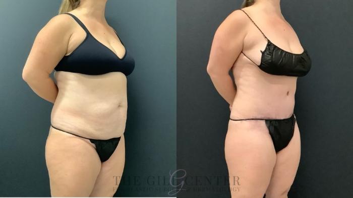 Tummy Tuck Case 631 Before & After Right Side | The Woodlands, TX | The Gill Center for Plastic Surgery and Dermatology