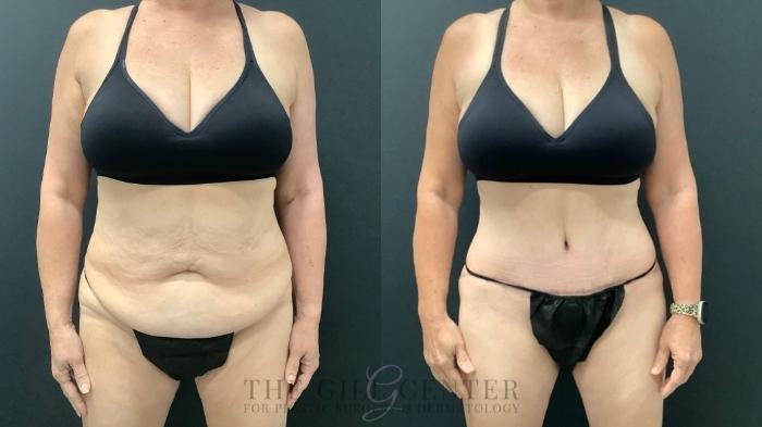Tummy Tuck Case 633 Before & After Front | The Woodlands, TX | The Gill Center for Plastic Surgery and Dermatology