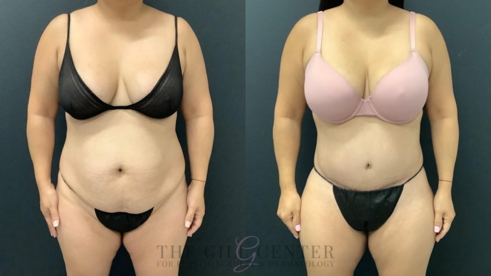 Tummy Tuck Case 635 Before & After Front | The Woodlands, TX | The Gill Center for Plastic Surgery and Dermatology