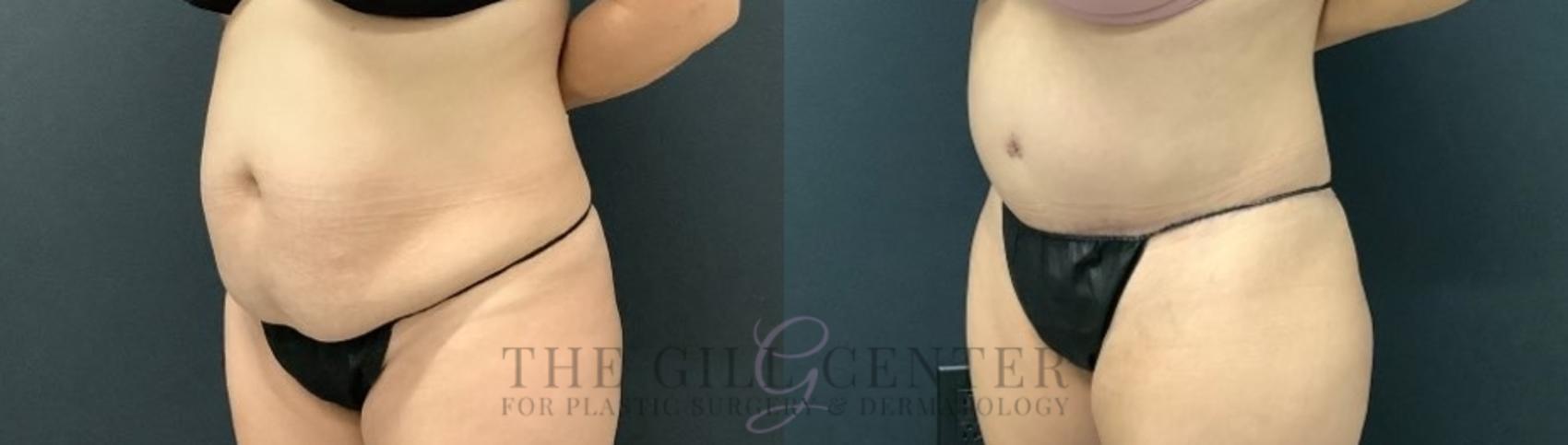 Tummy Tuck Case 635 Before & After Left Oblique | The Woodlands, TX | The Gill Center for Plastic Surgery and Dermatology