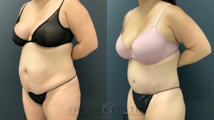 Tummy Tuck Case 635 Before & After Left Oblique | The Woodlands, TX | The Gill Center for Plastic Surgery and Dermatology