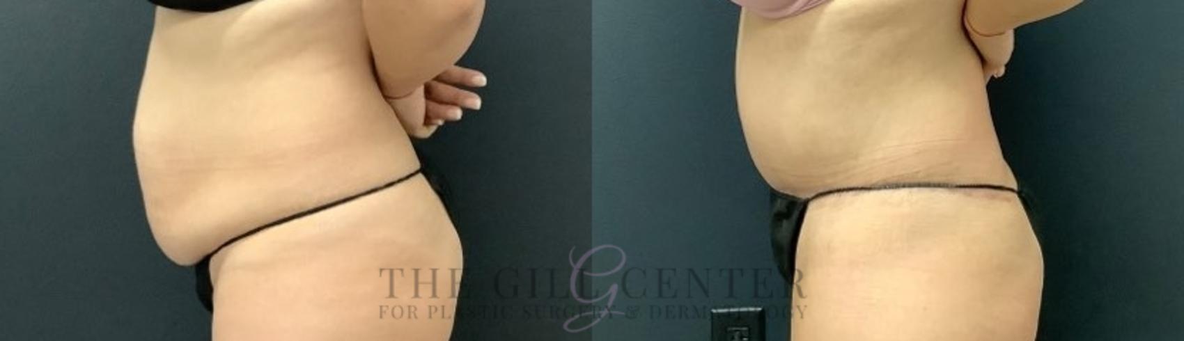 Tummy Tuck Case 635 Before & After Left Side | The Woodlands, TX | The Gill Center for Plastic Surgery and Dermatology