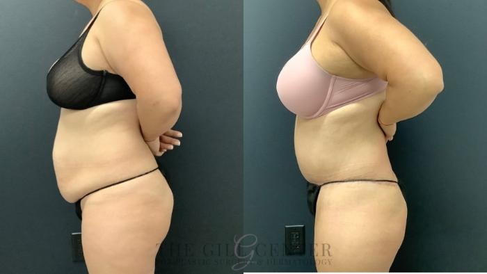 Tummy Tuck Case 635 Before & After Left Side | The Woodlands, TX | The Gill Center for Plastic Surgery and Dermatology