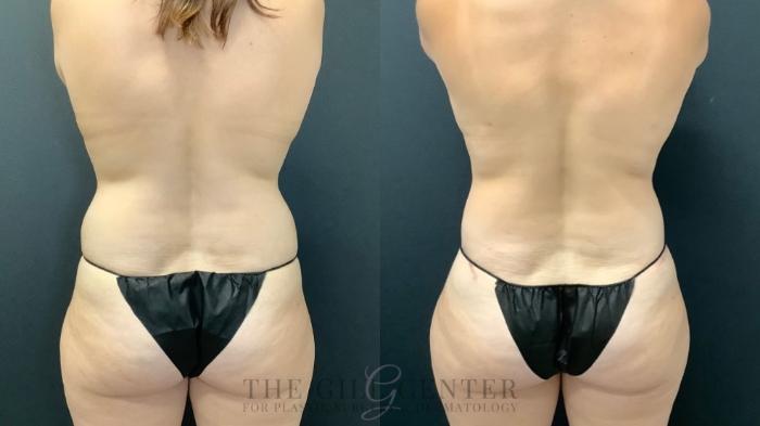 Tummy Tuck Case 636 Before & After Back | The Woodlands, TX | The Gill Center for Plastic Surgery and Dermatology