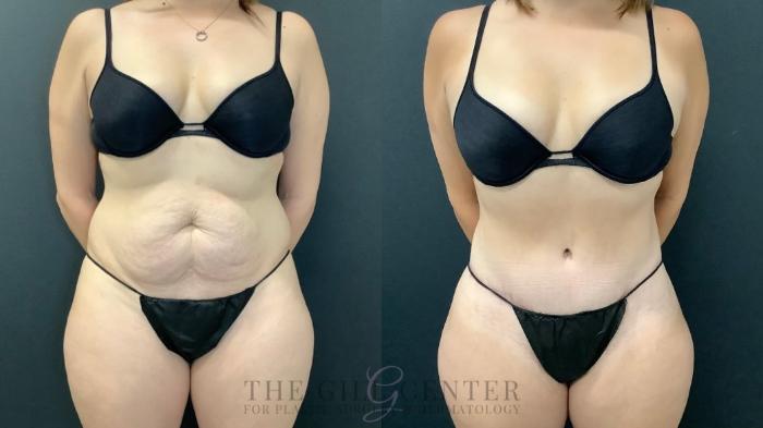 Tummy Tuck Case 636 Before & After Front | The Woodlands, TX | The Gill Center for Plastic Surgery and Dermatology