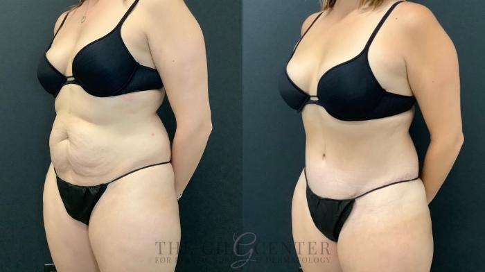 Tummy Tuck Case 636 Before & After Left Oblique | The Woodlands, TX | The Gill Center for Plastic Surgery and Dermatology