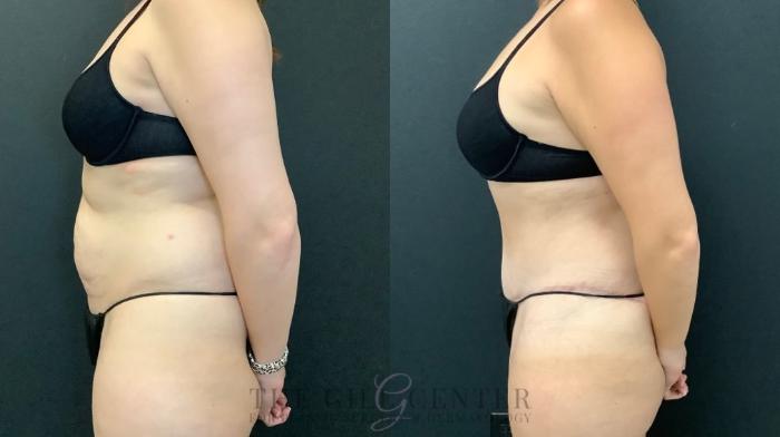 Tummy Tuck Case 636 Before & After Left Side | The Woodlands, TX | The Gill Center for Plastic Surgery and Dermatology