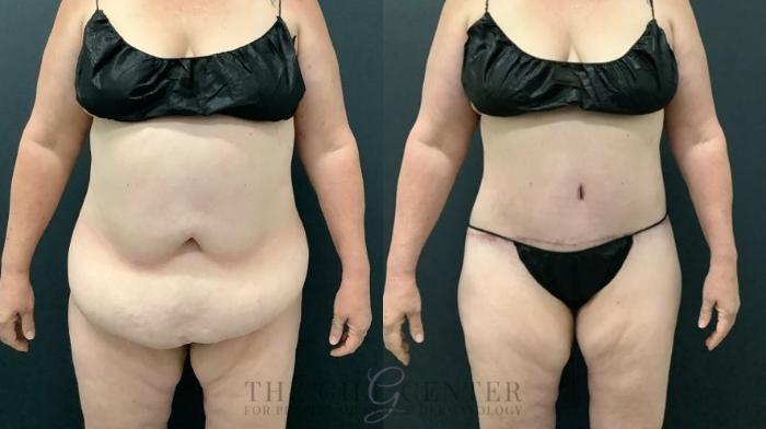 Tummy Tuck Case 644 Before & After Front | The Woodlands, TX | The Gill Center for Plastic Surgery and Dermatology