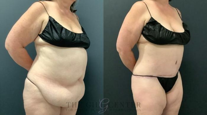 Tummy Tuck Case 644 Before & After Right Oblique | The Woodlands, TX | The Gill Center for Plastic Surgery and Dermatology