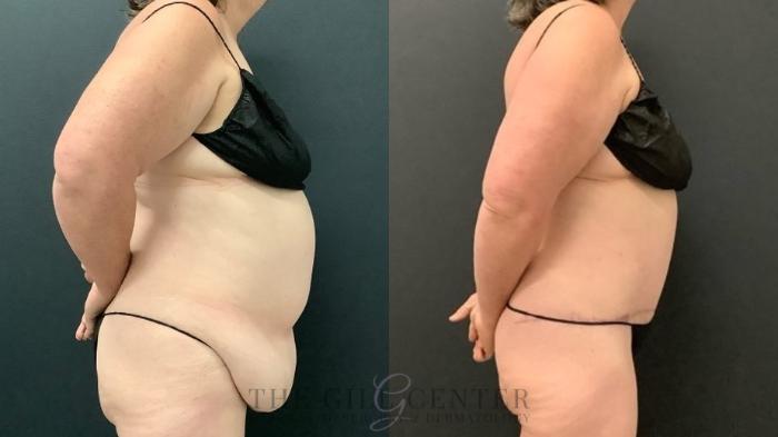 Tummy Tuck Case 644 Before & After Right Side | The Woodlands, TX | The Gill Center for Plastic Surgery and Dermatology