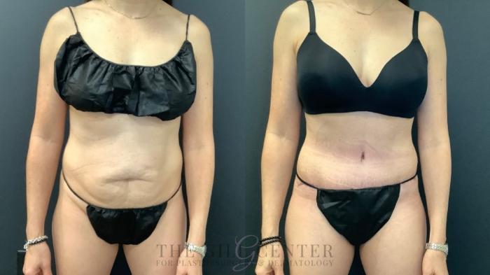 Tummy Tuck Case 649 Before & After Front | The Woodlands, TX | The Gill Center for Plastic Surgery and Dermatology