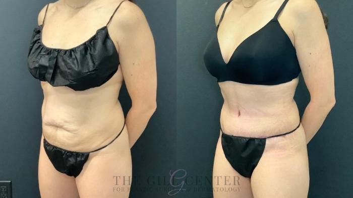 Tummy Tuck Case 649 Before & After Left Oblique | The Woodlands, TX | The Gill Center for Plastic Surgery and Dermatology