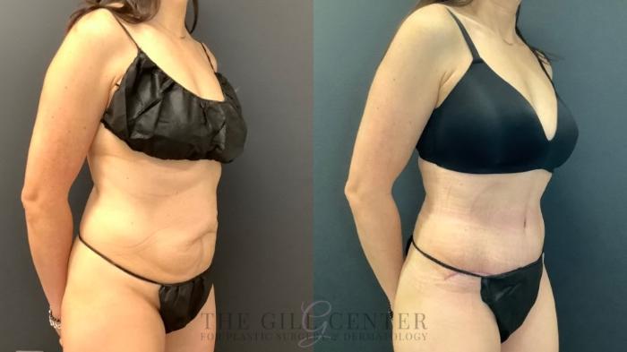 Tummy Tuck Case 649 Before & After Right Oblique | The Woodlands, TX | The Gill Center for Plastic Surgery and Dermatology